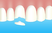 Notfall Abgebrochener Zahn